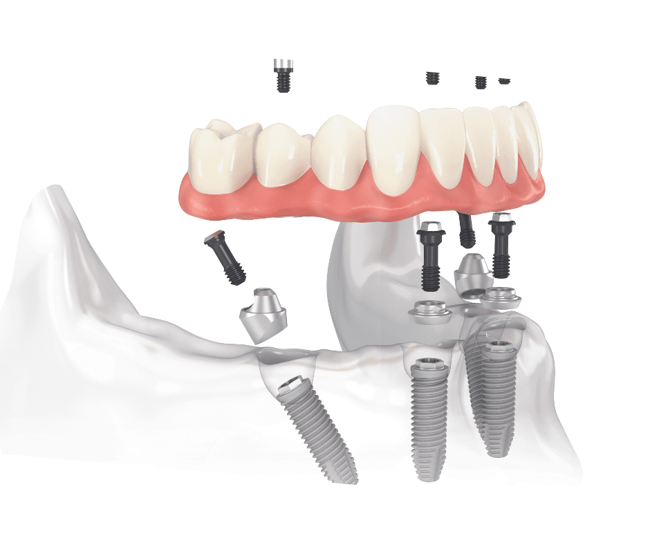 All-on-4 implant