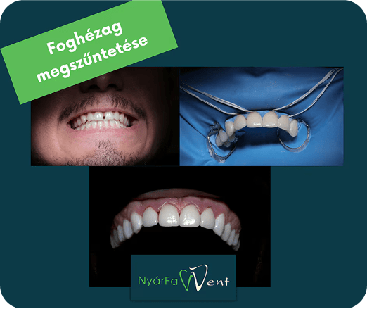 Foghézag – fogpótlás előtt