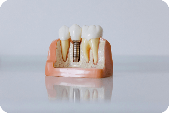 Implantcentrum – NyárFa Dent, Győr