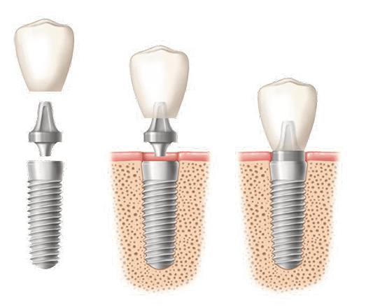 Fogászati implantáció – NyárFa Dent, Győr