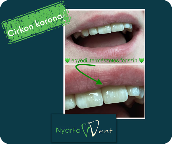 Fogpótlás – NyárFa Dent, Győr