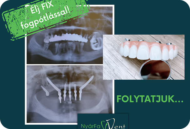 Fogpótlás – NyárFa Dent, Győr
