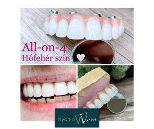 All-on-4 implantátum