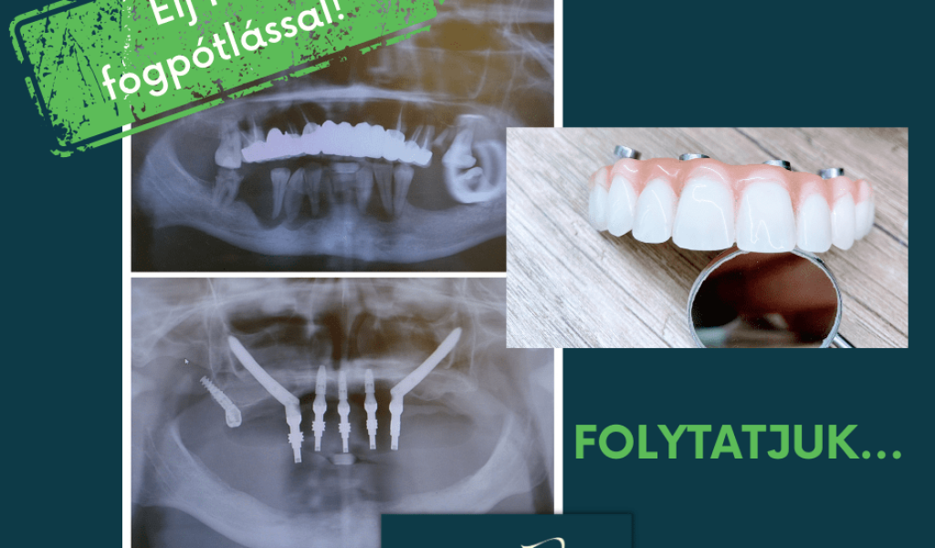 Győr szájsebészet Zygoma fix implantátum