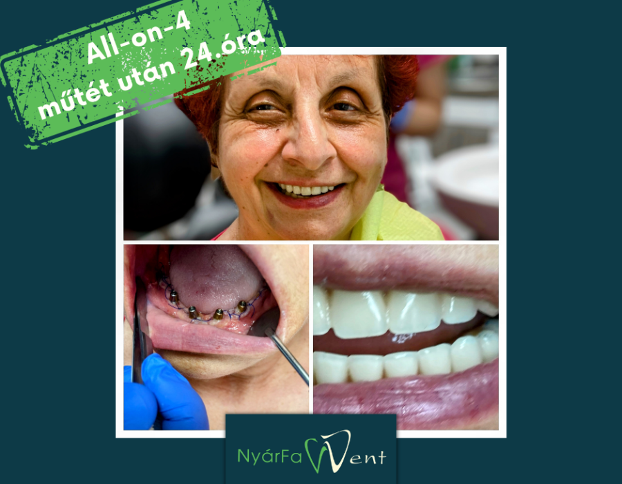 fogaszáti implantátum Győr szájsebészet Nobel