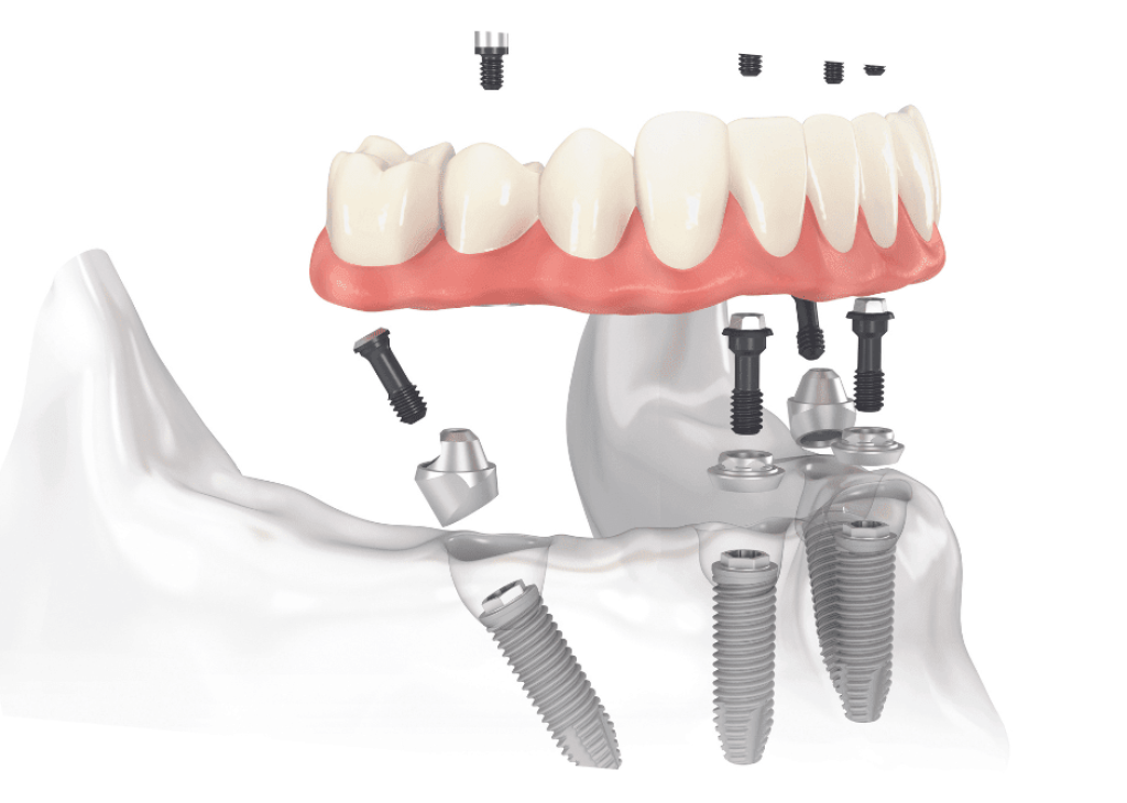 All-on-4 implnatum behelyezése Győr szájsebészet implantáció